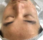 acne after treatment Wimbledon and Kensington