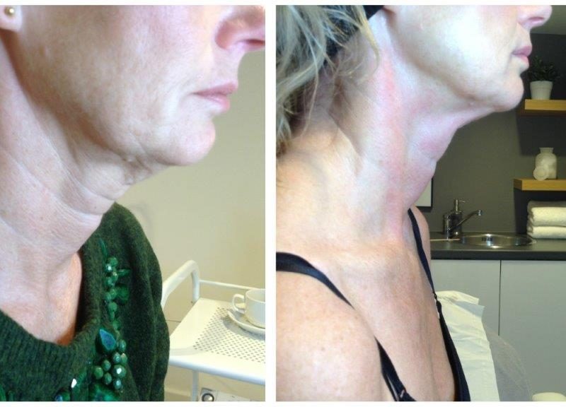 Venus freeze before and after