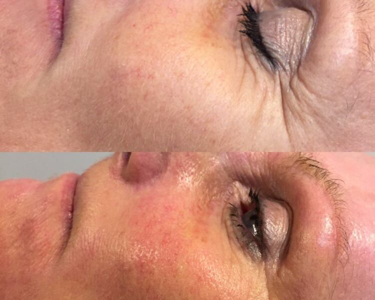Dermapen Micro-needling before and after