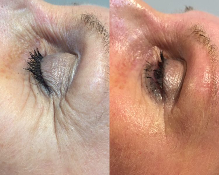 Dermapen Micro-needling before and after
