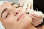 Eden Skin Clinic Microneedling Kensington, Wimbledon