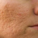 acne scarring treatment Kensington and Wimbledon