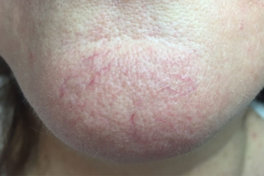 thread vein treatments london