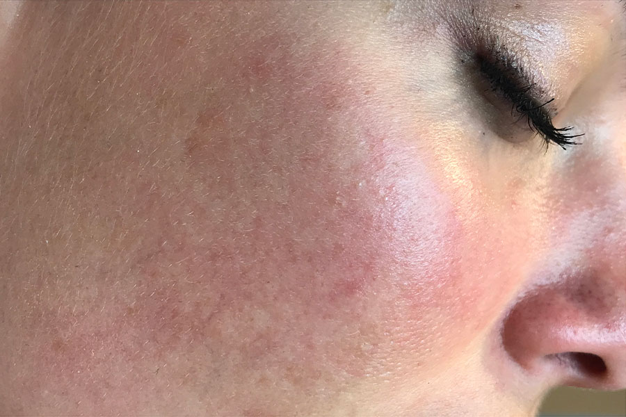 What Treatments Help Relieve Rosacea?