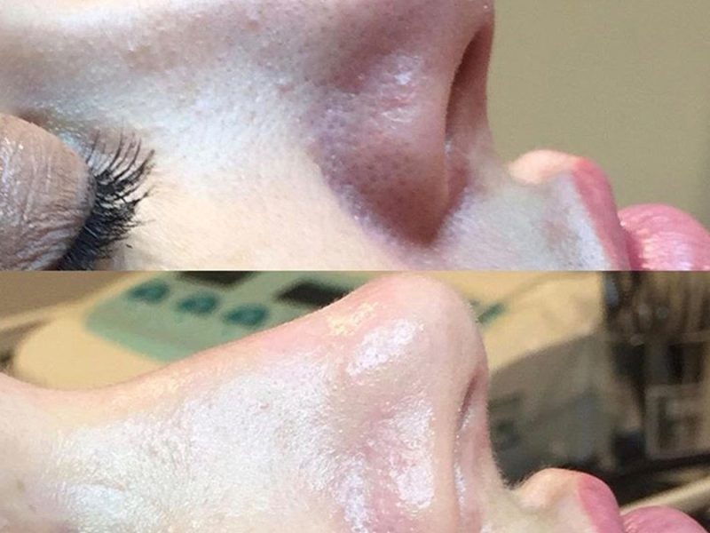 Medical Microdermabrasion Before & After
