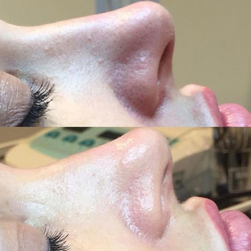 Medical Microdermabrasion Before & After