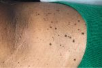 Dermatosis Papulosa Nigra treatments local to me london