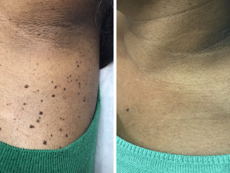 Dermatosis Papulosa Nigra before and after wimbledon