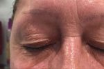 Drooping eyelid treatment wimbledon