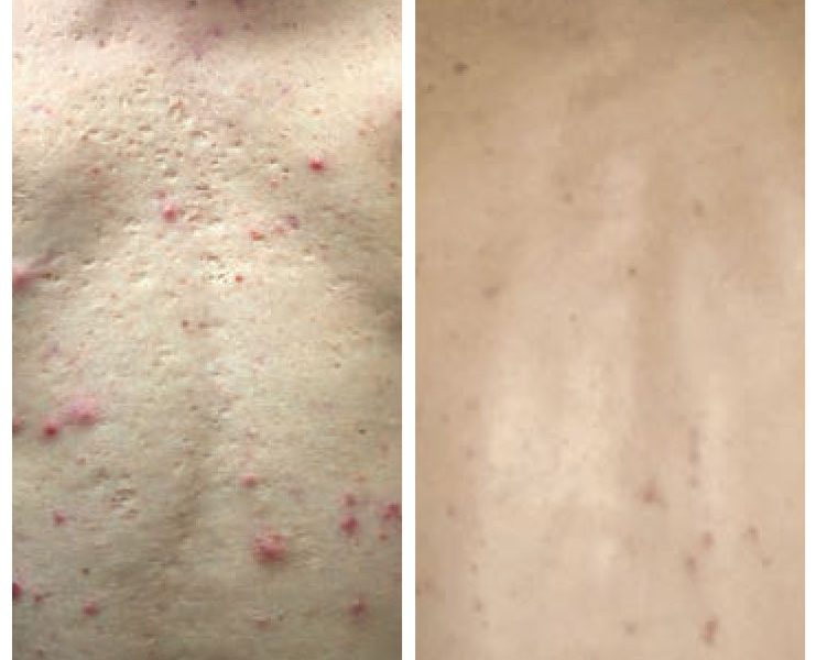 alumier-before-after-