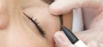 Electrolysis hair removal London