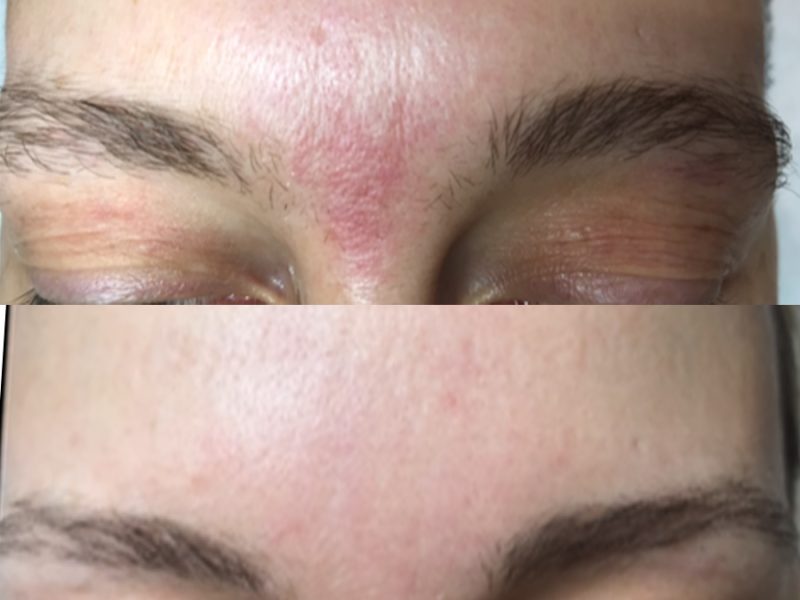 Birthmark Removal before & after