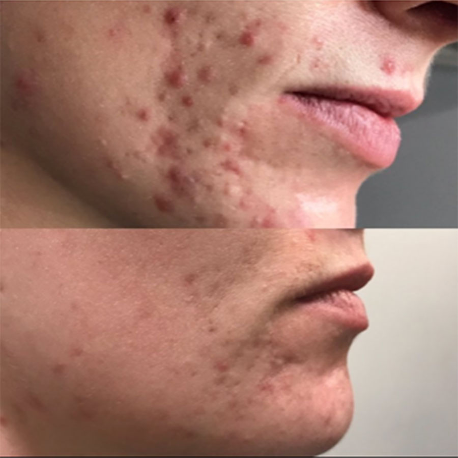 Ameson Mesopeel® Chemical Peels Before and After