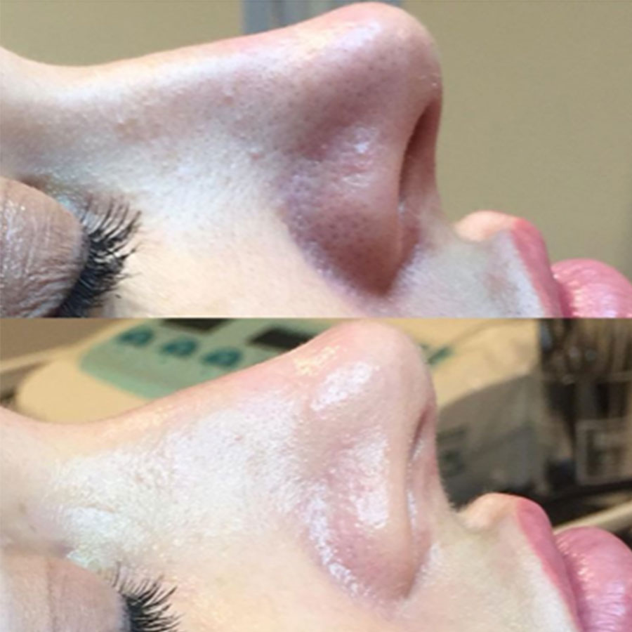 Everything You Need to Know About Ameson Mesopeel Chemical Peels