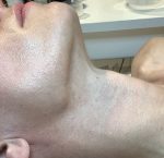 Radiant Peel- After Image