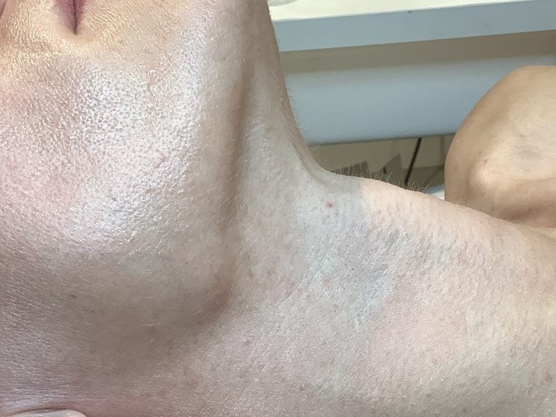Radiant Peel- After Image