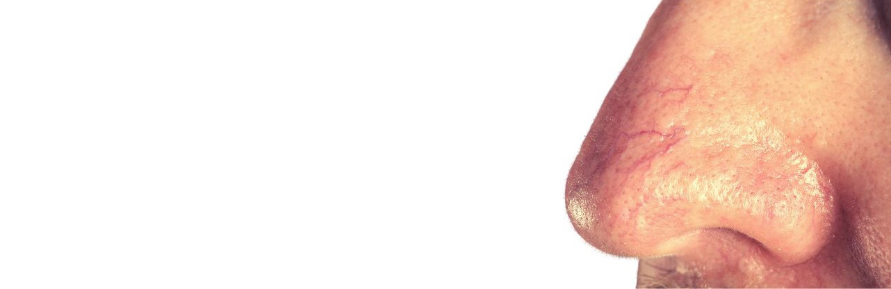 Thread Vein treatments kensington