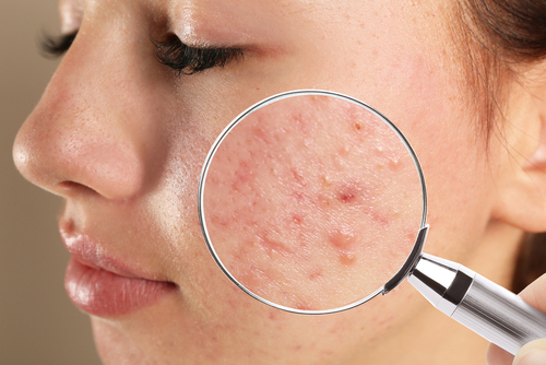 7 Hidden Causes of Adult Acne (That No One Talks About)