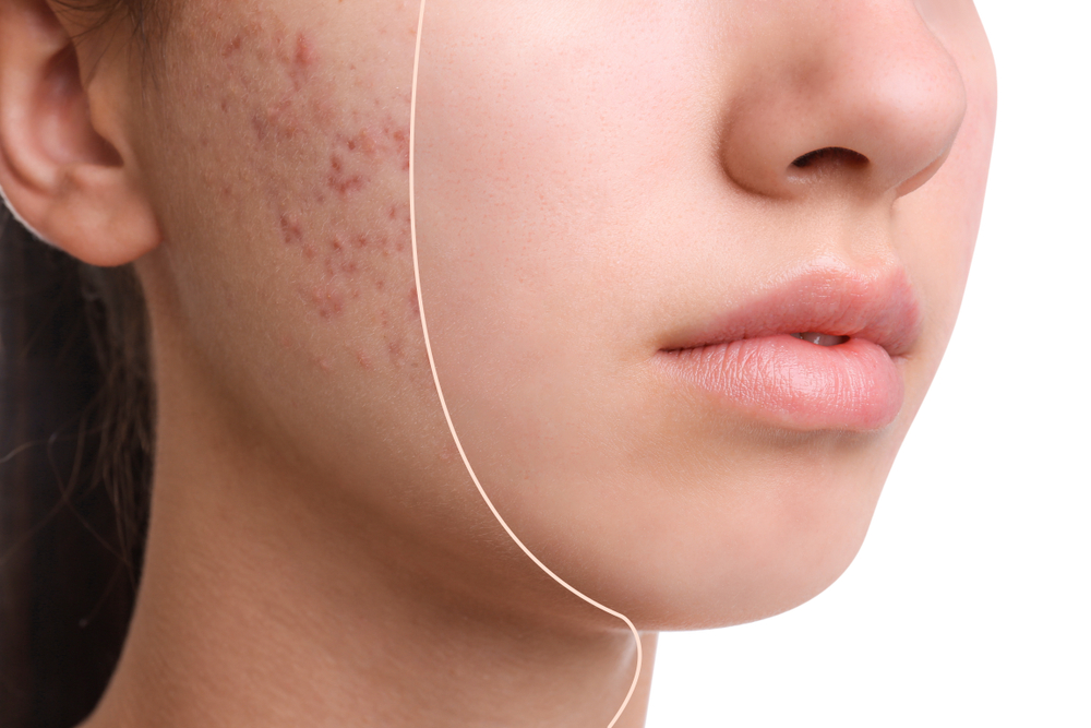 Acne treatment prices Wimbledon & Kensington