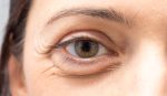 eye bag clinic treatment kensington