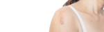 birthmark treatment near me wimbledon and kensington