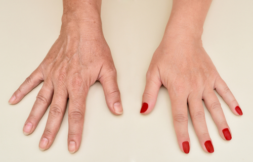 aging hand treatments Wimbledon