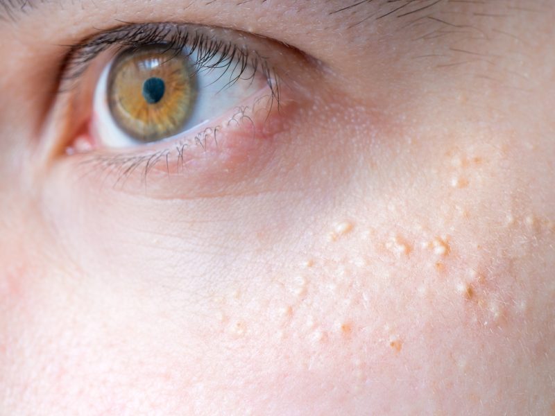 How is Milia Caused?