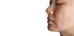 acne scarring treatment near me Wimbledon & Kensington