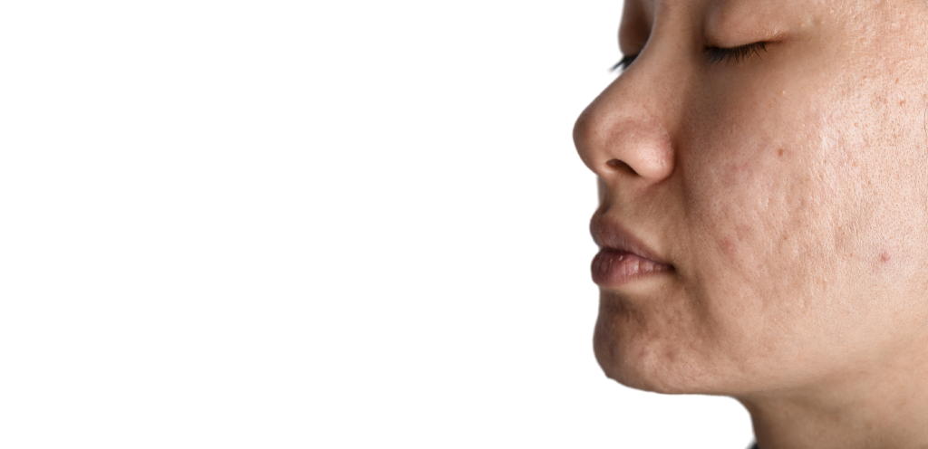 acne scarring treatment near me Wimbledon & Kensington