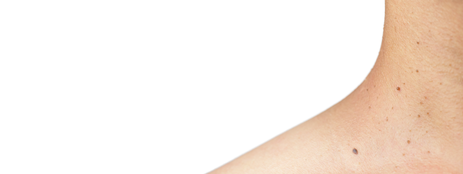 Skin Tag treatments near me London