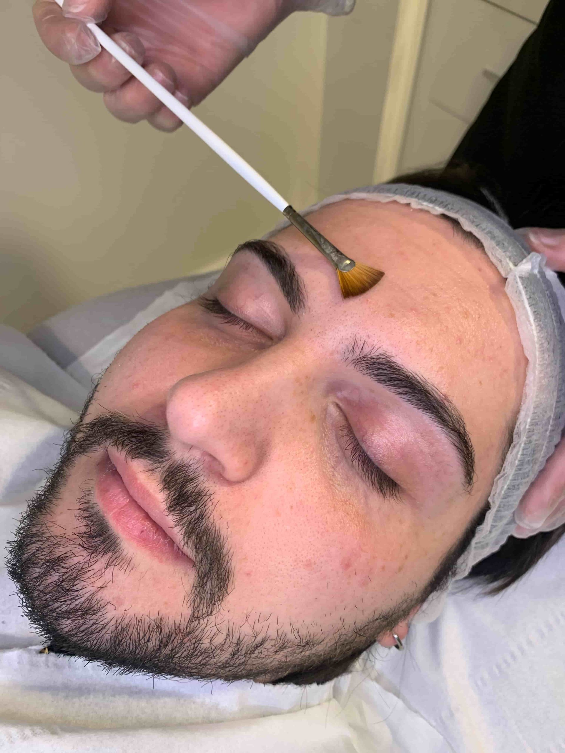 Mesopeel chemical peel treatments London