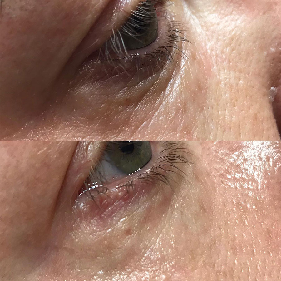 accor plasma pen treatment prices