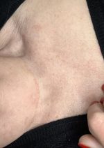 age spots after skin treatment kensington