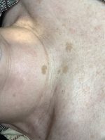 cryopen age spots treatment Kensington