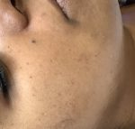 acne hydrafacial for skin pigmentation treatment