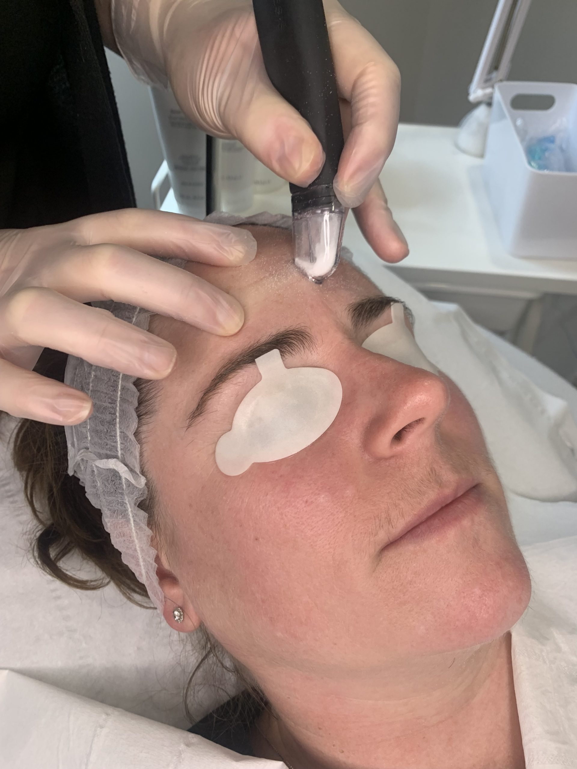 Microdermabrasion treatment prices Kensington