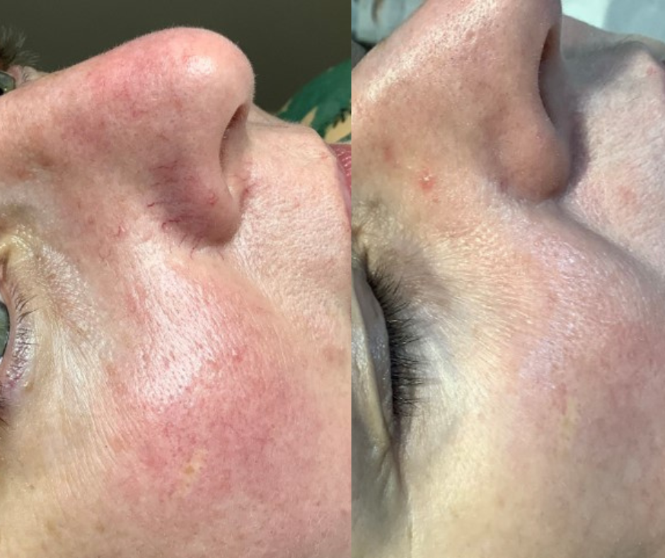 thread vein removal London