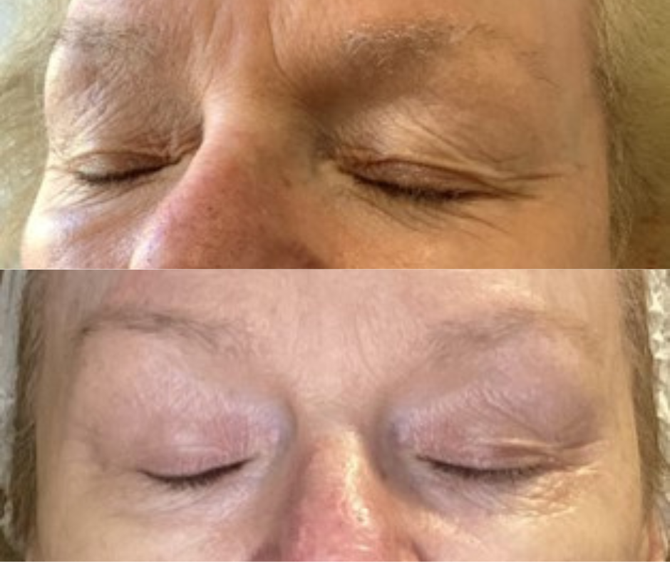Drooping eyelid treatment before and after