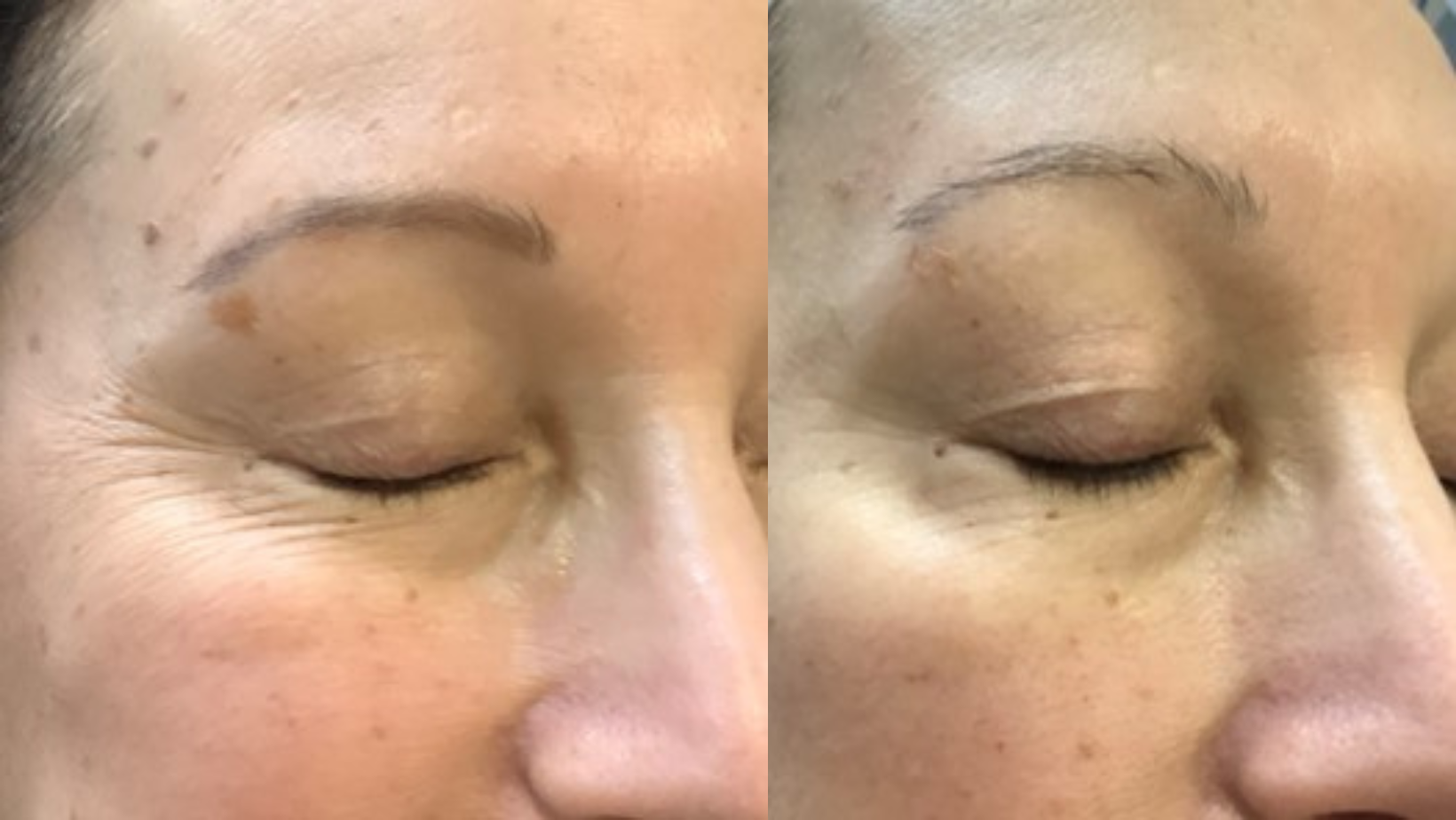 Venus Freeze Skin Tightening Treatment Cost, London