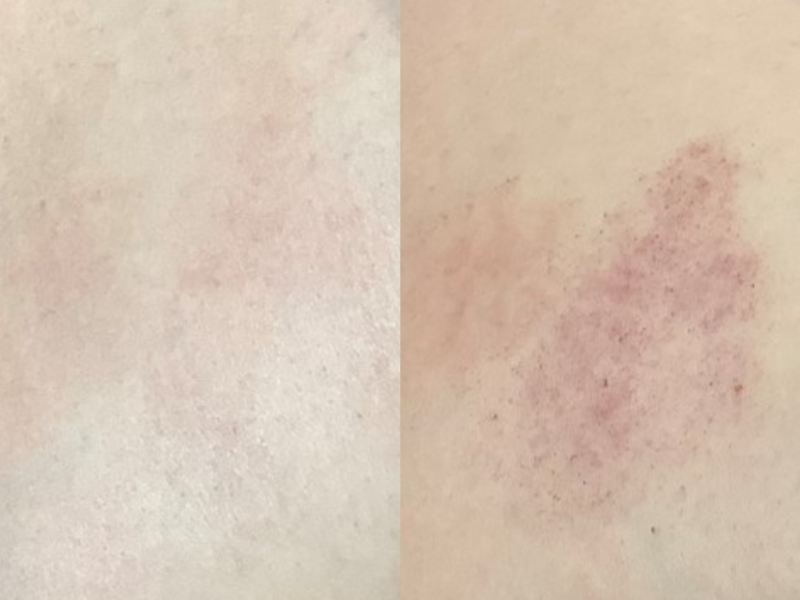 birthmark before & after