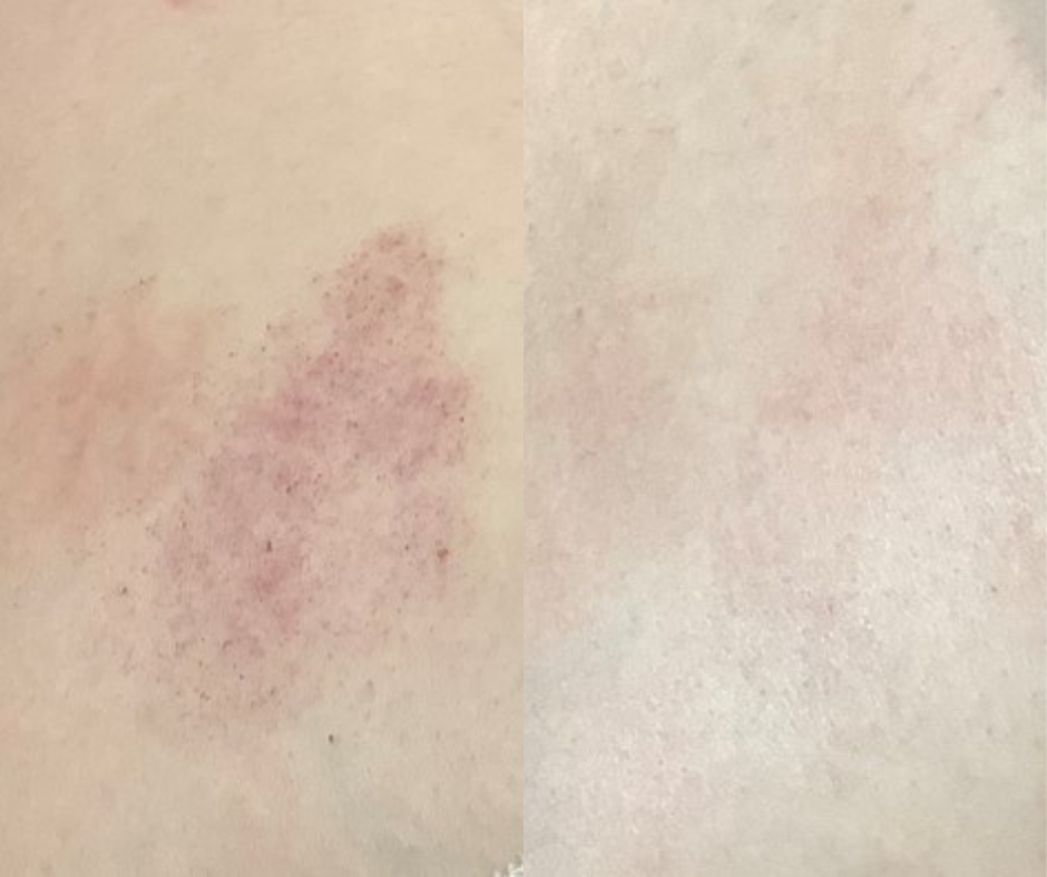 Birthmark before & after kensington and wimbledon