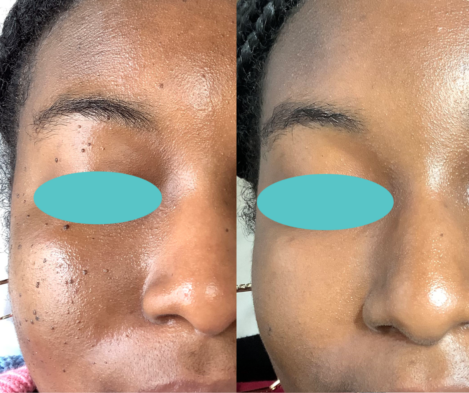 Dermatosis Papulosa Nigra Treatment Wimbledon Kensington