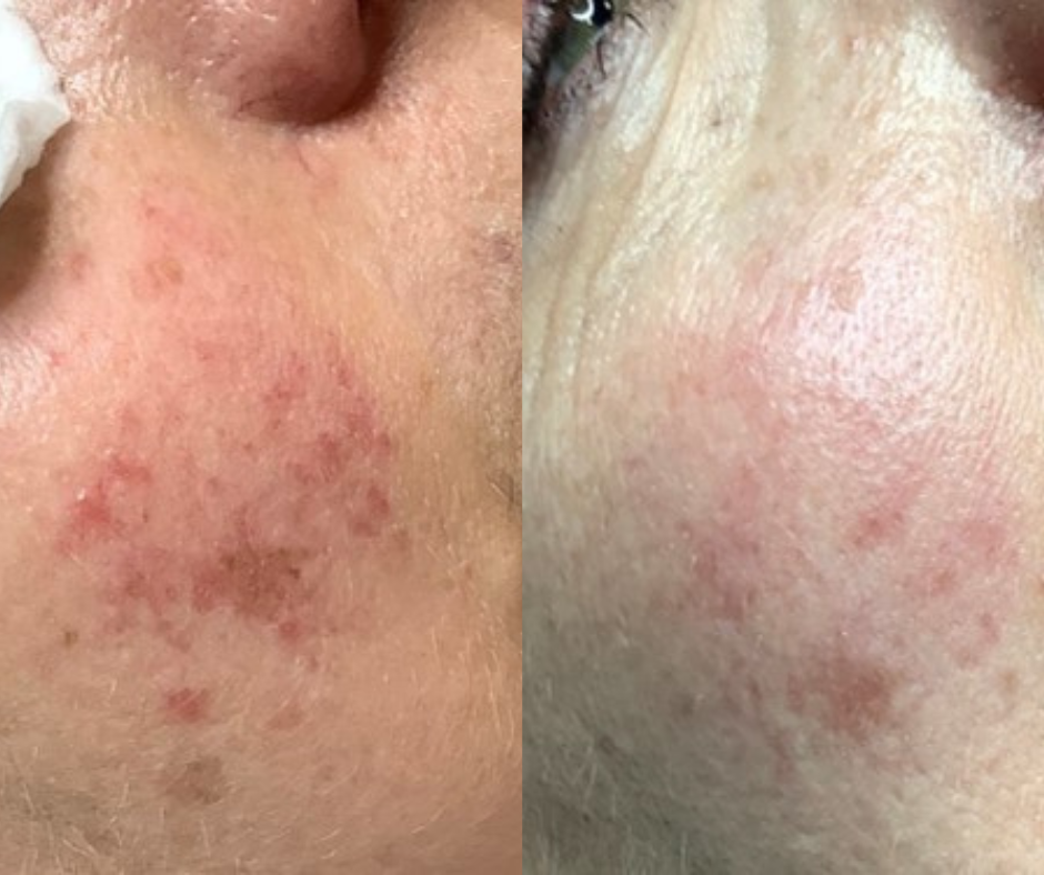 Rosacea treatments London