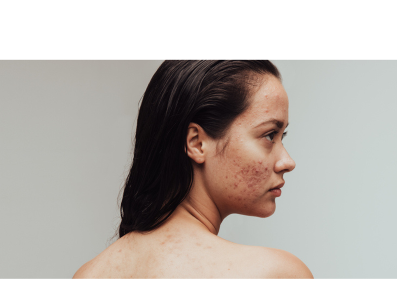 Acne Scars: Best Treatments to Achieve Smooth, Even-Toned Skin