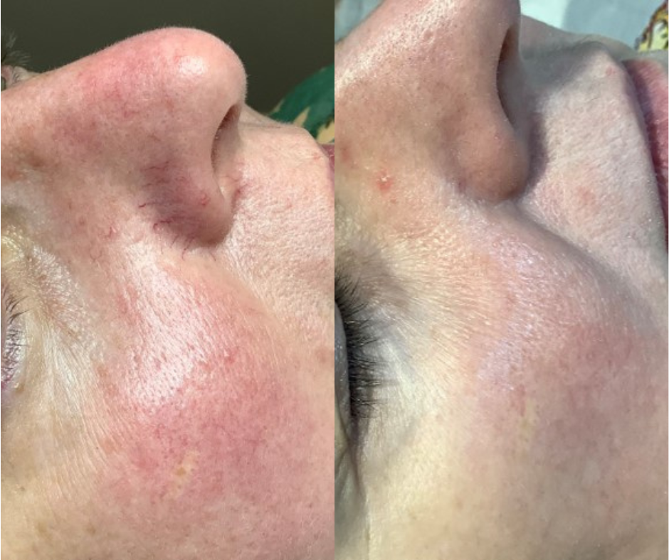 thread vein treatments London