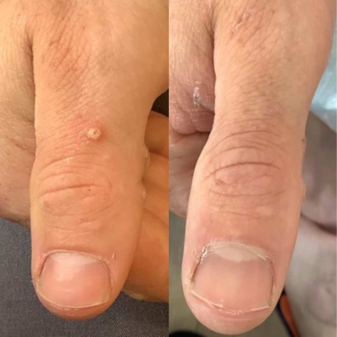 wart treatments london