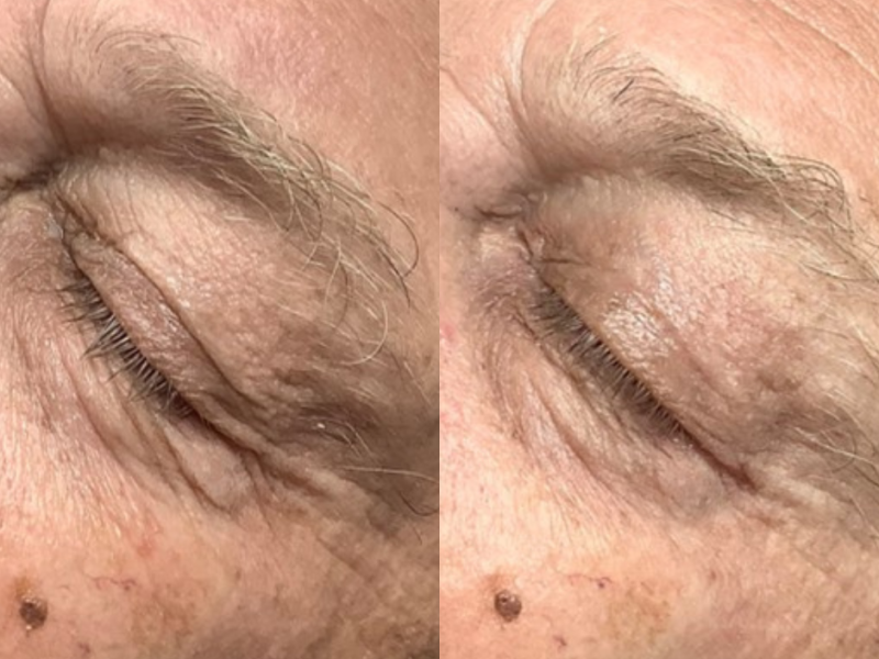accor eye bag treatments before & after