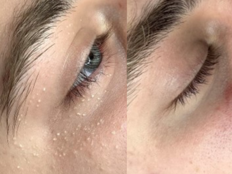 milia before & after london eden skin clinic