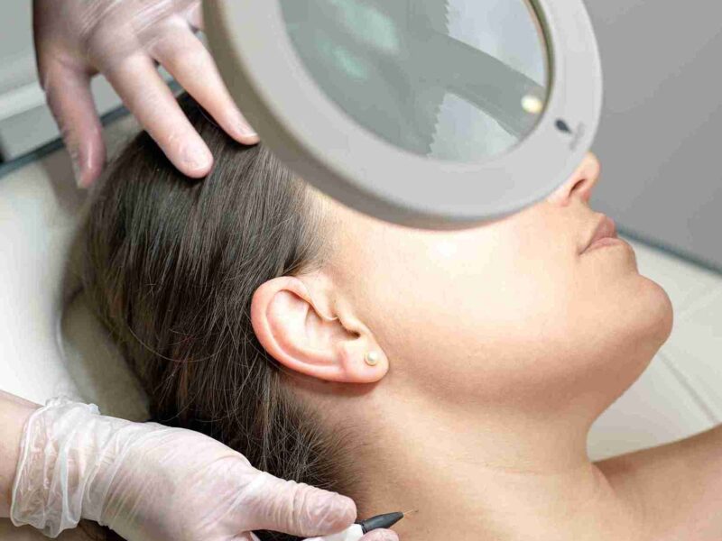 advanced electrolysis treatments Wimbledon & Kensington closed comedones