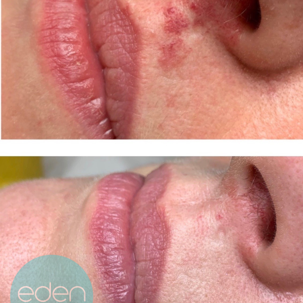 birthmark removal before & after